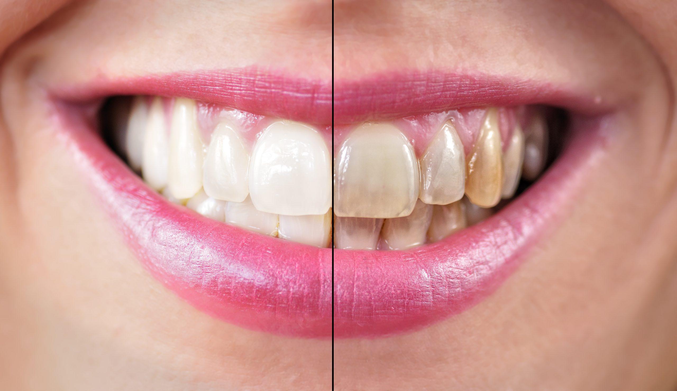 How Smoking Affects Teeth and Gums Over Time